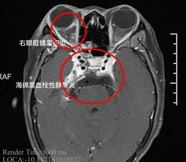 %title插图%num 女孩挤痘引发颅内感染-WordPress极简博客